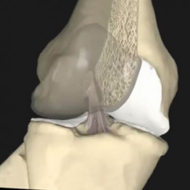 Newsletter nº8 - Fibras no Tratamento de Lesões Desportivas